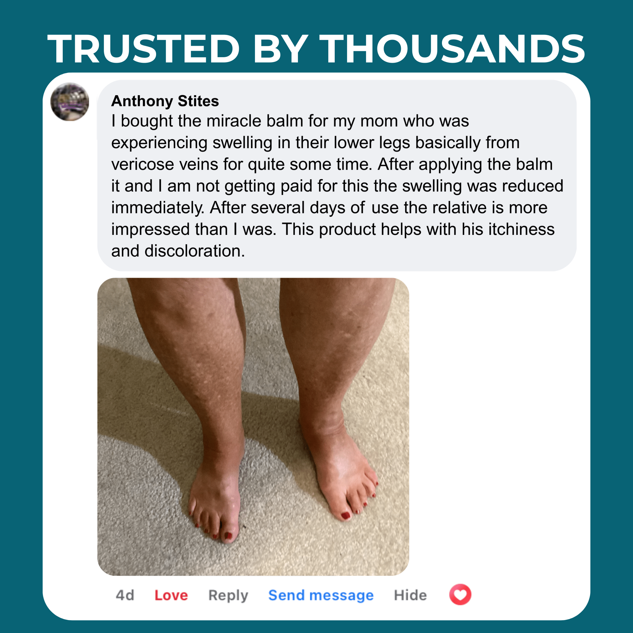 Senzio Miracle Balm™ - Relief for Swollen Legs, Ankles & Feet - SenzioSenzioSenzio Miracle Balm™ - Relief for Swollen Legs, Ankles & Feet